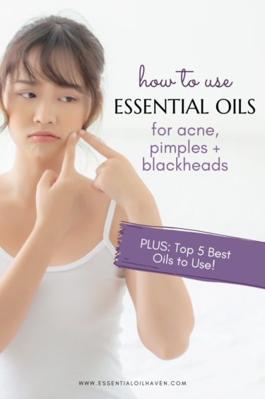 essential oils for acne