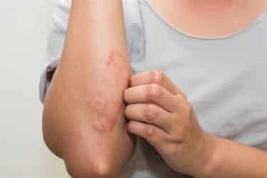 eczema skin rash on forearm