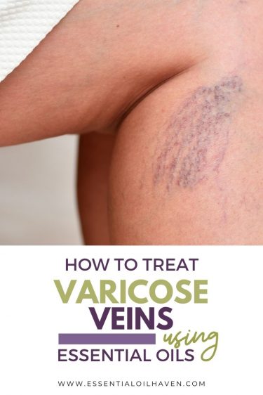 how to treat varicose veins with essential oils