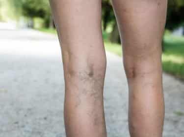 Legs showing Varicose Veins