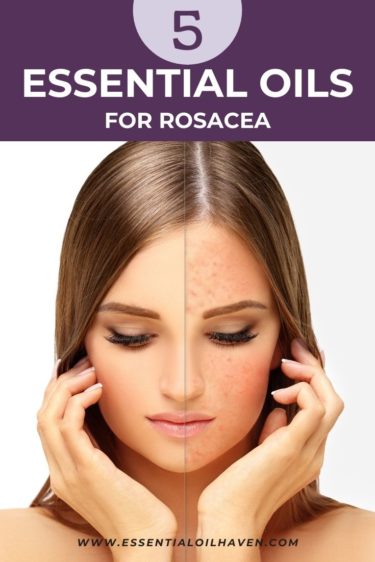 best essential oils for rosacea